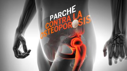 UNAM desarrolla parche para tratar osteoporosis